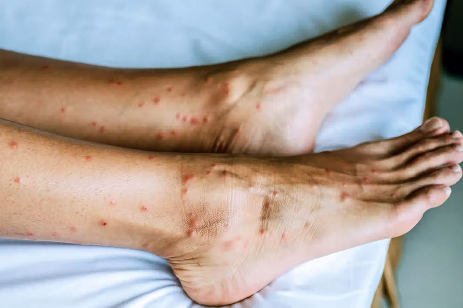 Allergic Reactions to Bed Bug Bites