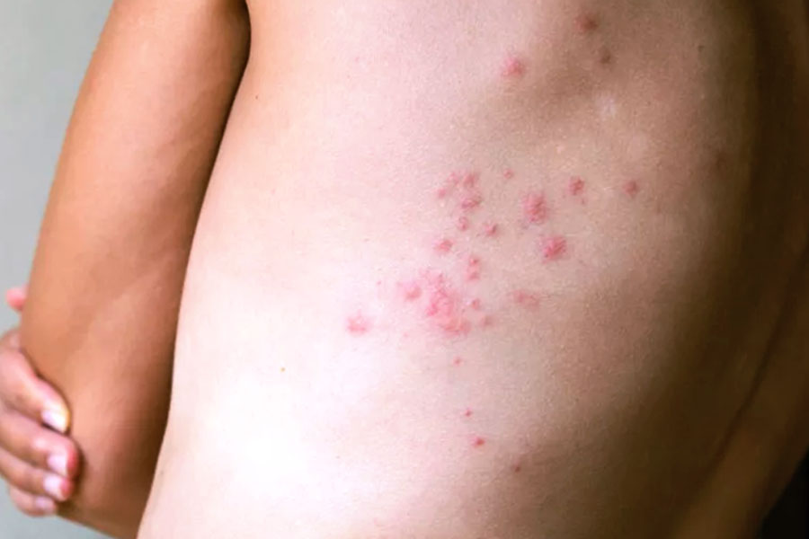 Are Bed Bug Bites Painful