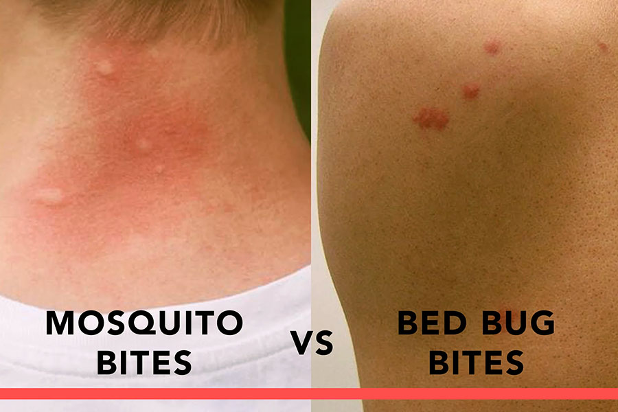 Comparisons With Other Insect Bites