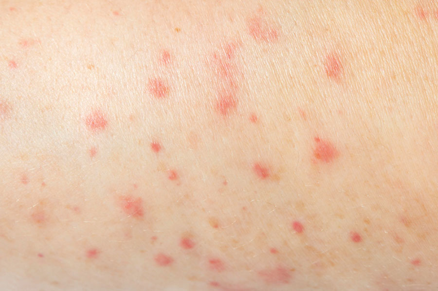 Potential Skin Infections