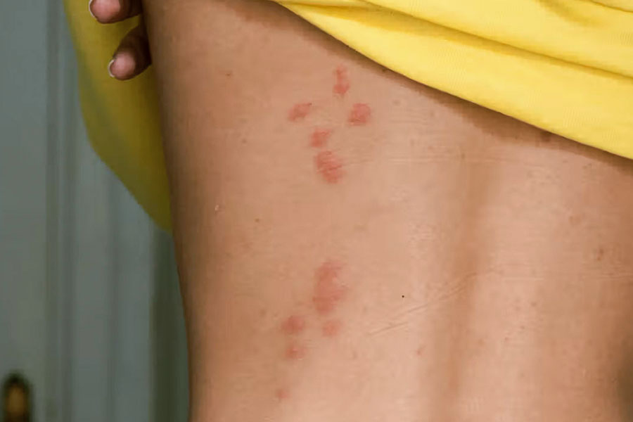 What Can I Put on My Skin to Prevent Bed Bug Bites